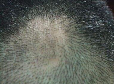 脂溢性皮炎有哪些症状