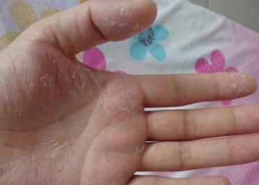 湿疹发病的原因是什么